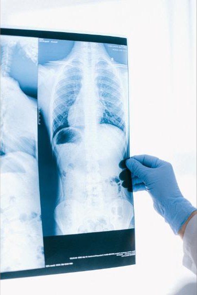 Hand im Untersuchungshandschuh hält ein Röntgenbild des Oberkörpers ins Licht